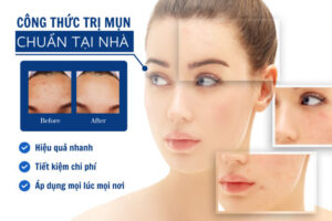 Công thức mỹ phẩm – Hỗ trợ điều trị MỤN hiệu quả tại nhà